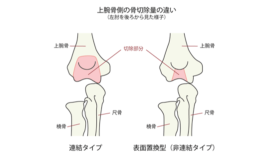 稲垣 克記 先生 第102回 よくある肘の病気やケガ ダイジェスト版 肘の痛みの原因とその治療法 人工関節ドットコム