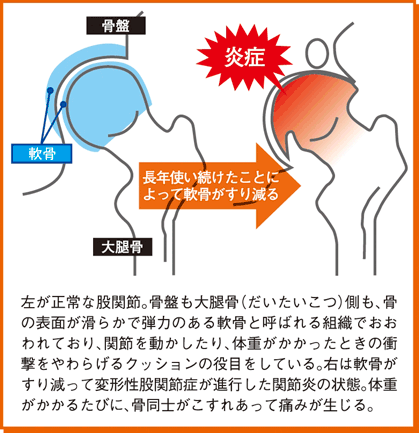 炎症のメカニズム