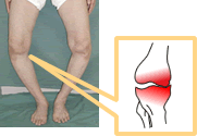 変形性膝関節症