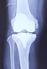 人工膝関節置換術後のレントゲン