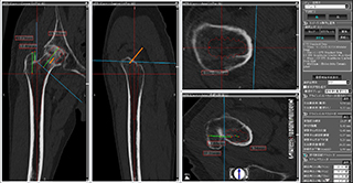 ３Ｄ術前計画 ステム