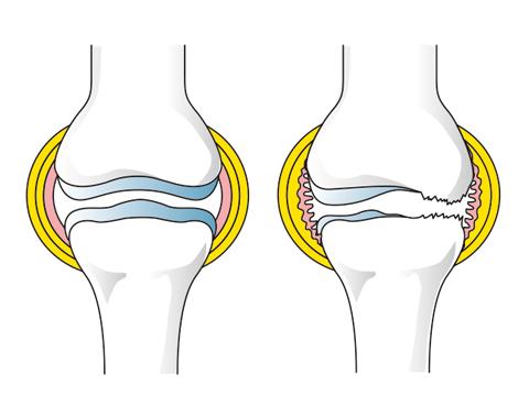 正常な膝（左）と軟骨がなくなった膝（右）