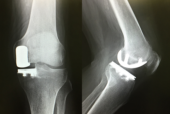 部分置換術後のX線（正面と側面）