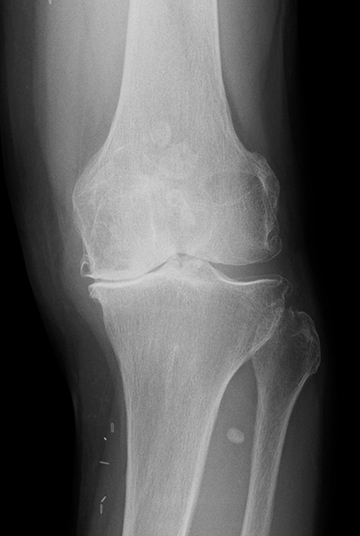 変形性膝関節症のレントゲン
