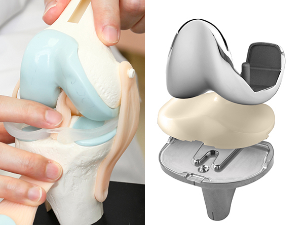 人工膝関節の一例