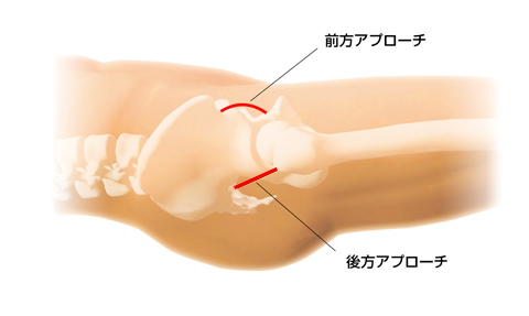 手術のアプローチ