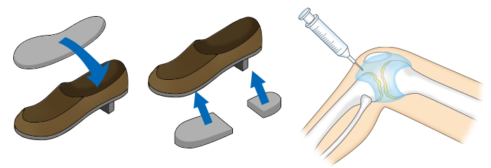 足底板と関節内注射