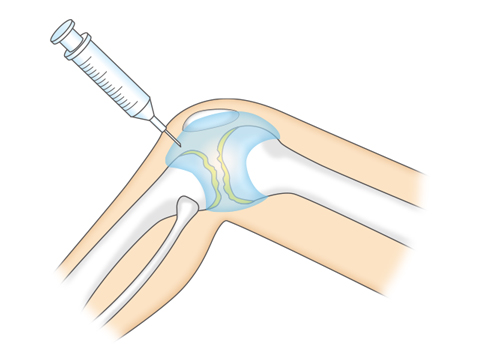 ヒアルロン酸注射