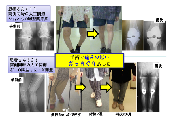 変形性膝関節症の治療は虫歯の場合と同じ