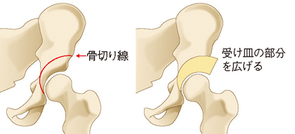 骨切り術