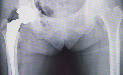 人工股関節置換術後のX線