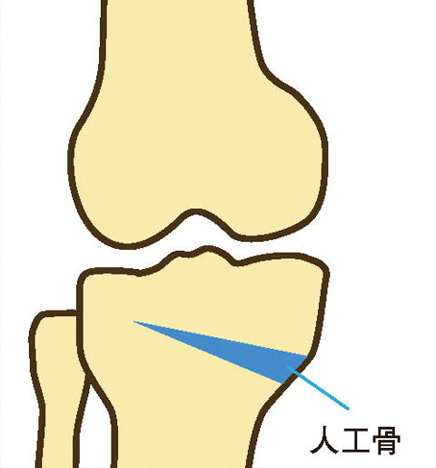 骨切り術