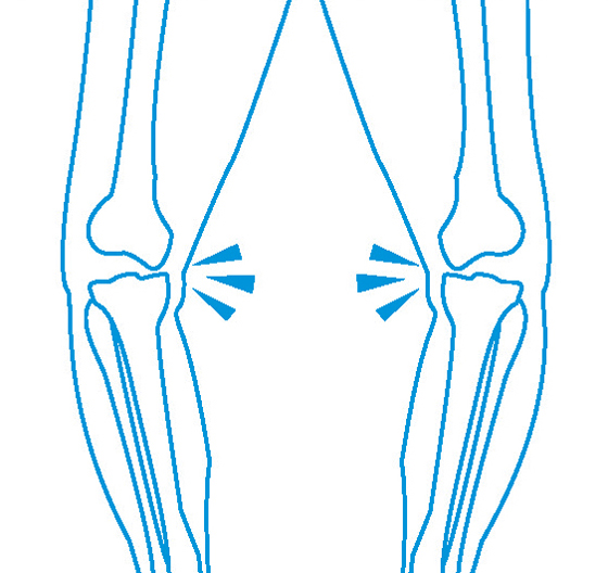 O脚による変形性膝関節症
