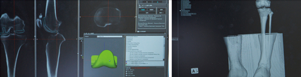３Ｄプリンターを導入したシミュレーションと術前計画