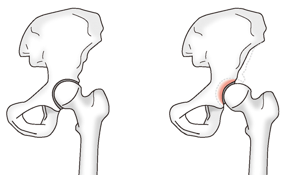 正常な股関節と寛骨臼形成不全