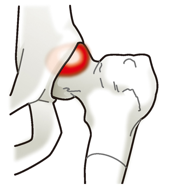 FAI（femoroacetabular impingement）:股関節インピンジメント