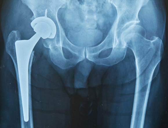 人工股関節置換術後のレントゲン