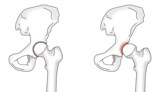 丸山 善弘 先生 股関節に痛みが起こる原因は 第160回 股関節の痛みは我慢しないで専門医に あなたに合った方法を教えてもらおう 人工関節ドットコム