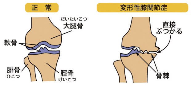 変形性膝関節症