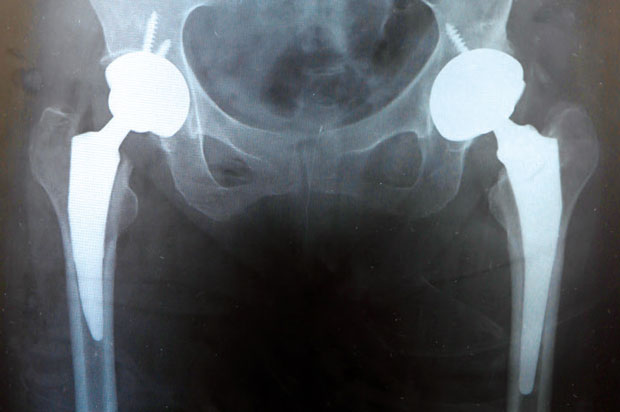 人工股関節置換術後のレントゲン（両脚）