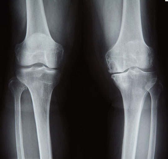 山本 重吉 先生 中高年の膝痛の原因は 第163回 筋力があれば 膝の痛みも軽くなる人工膝関節にもいろいろなタイプが 人工関節ドットコム