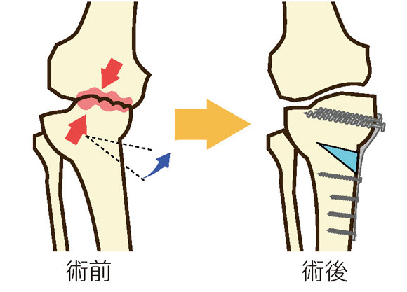 高位脛骨骨切り術