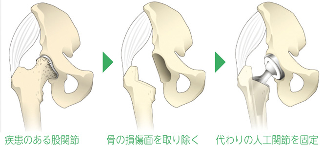 人工股関節全置換術の流れ