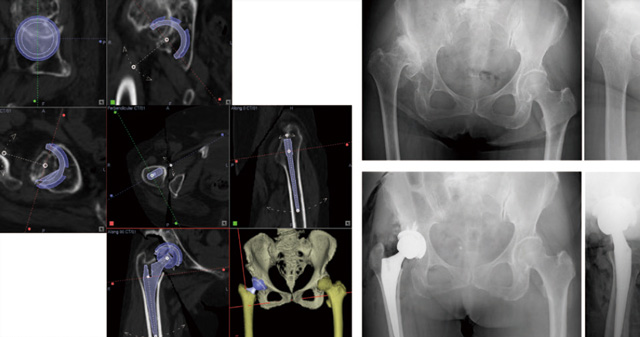 ナビゲーションでの術前計画と術前後のX線写真