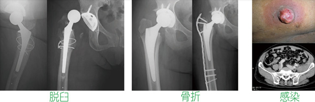 合併症