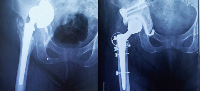 再置換術前（左）術後（右）のレントゲン