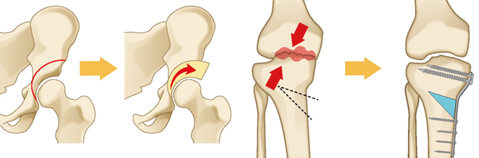 骨切り術（股関節と膝関節）
