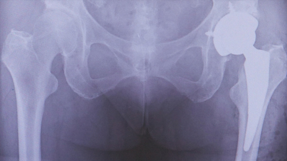 人工股関節置換術後のレントゲン