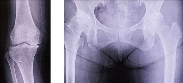 変形性膝関節症と変形性股関節症のレントゲン