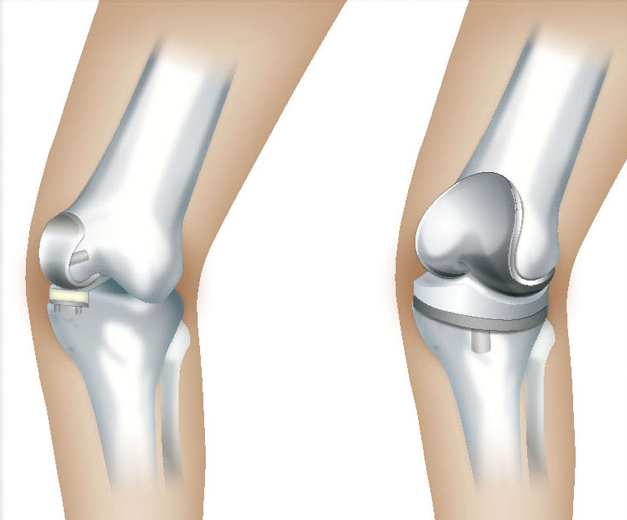 人工膝関節部分置換術（左）と全置換術（右）
