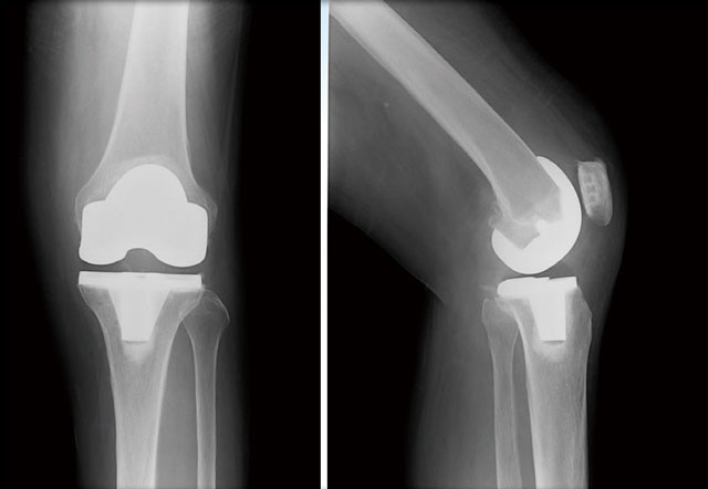 人工膝関節全置換術後のレントゲン