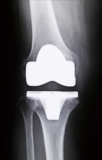 人工関節全置換術後のレントゲン