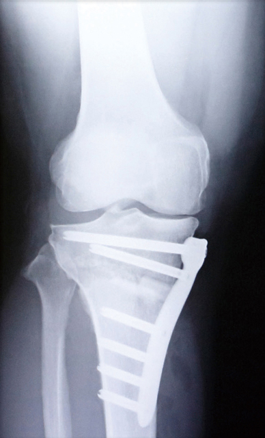 高位脛骨骨切り術後の
	レントゲン