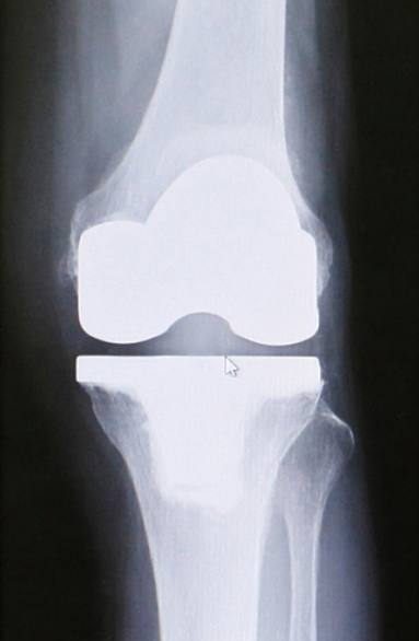 人工膝関節全置換術後のレントゲン