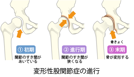 船山 敦 先生 日本人に多い 変形性股関節症 原因のほとんどは臼蓋形成不全 第19回 股関節の痛み 違和感や不具合は早めに股関節 の専門医に相談を 人工関節ドットコム