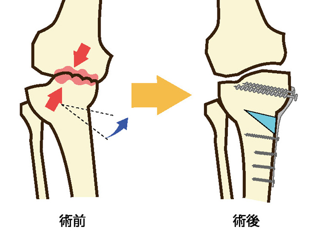 骨切り術