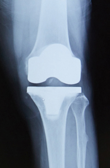 人工膝関節全置換術後のレントゲン