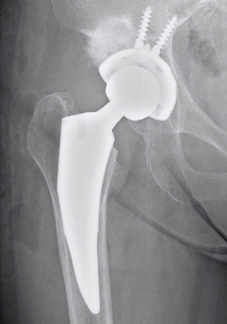人工股関節置換術後のレントゲン