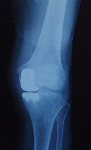 人工膝関節部分置換術後のレントゲン