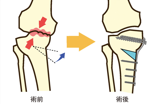 骨切り術