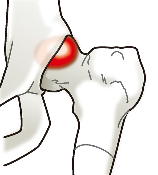 股関節唇損傷（大腿骨寛骨臼インピンジメント）