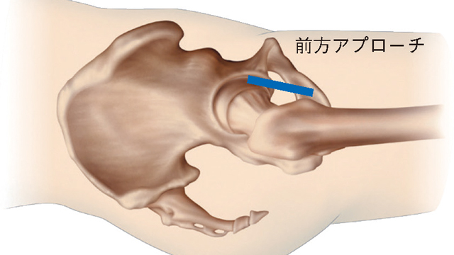 前方アプローチ　イメージ