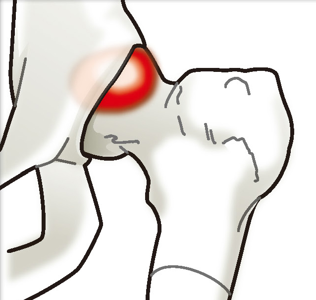 FAI（Femoroacetabular impingement＝股関節インピンジメント