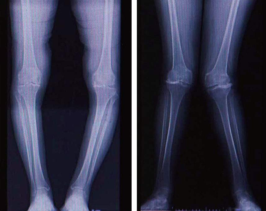 O脚とX脚のレントゲン