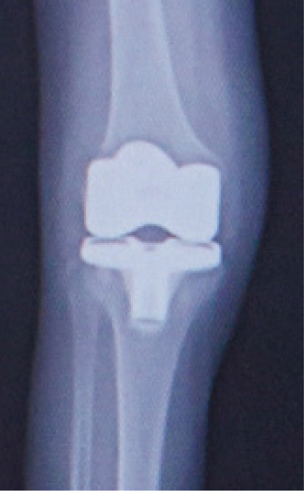 全置換術後のレントゲン