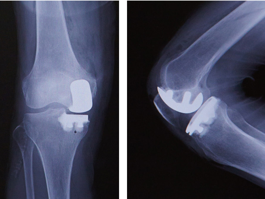 片側置換術後のレントゲン（正面と側面）